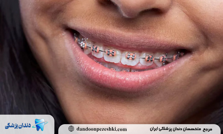 روش های ارتودنسی