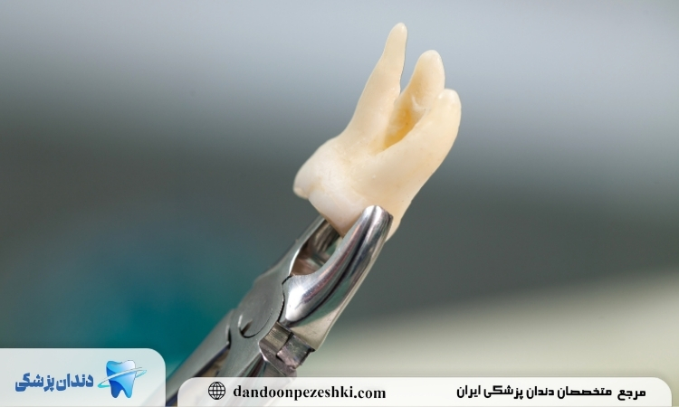 جراحی دندان عقل