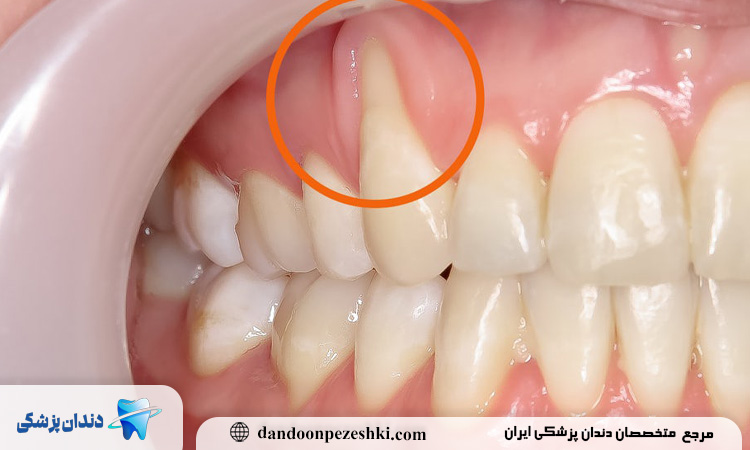 علت جدا شدن لثه از دندان
