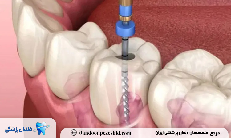 علل شکستگی ریشه دندان عصب کشی شده