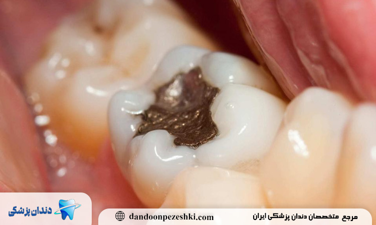 عوارض قورت دادن مواد پر کردن دندان