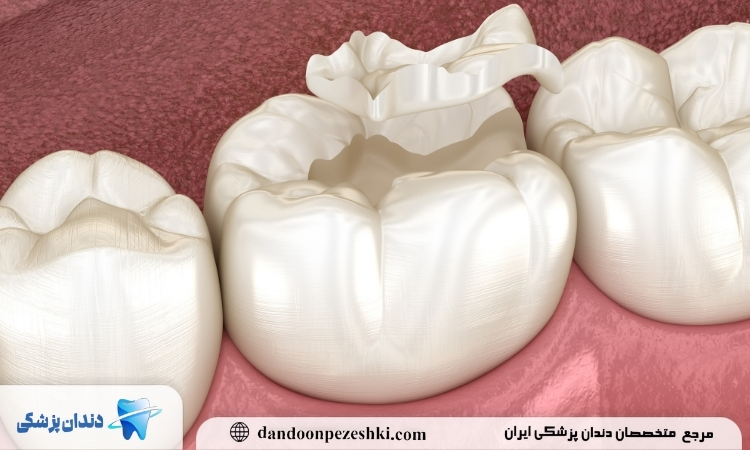 عوارض پر نکردن دندان بعد از عصب کشی