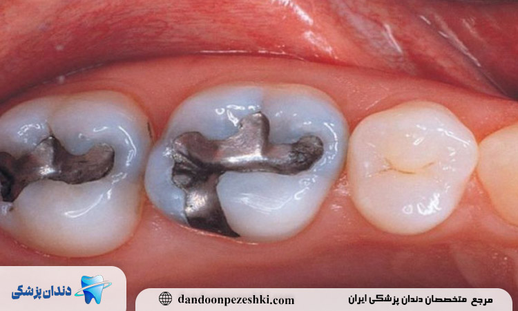 قورت دادن مواد پر شده دندان