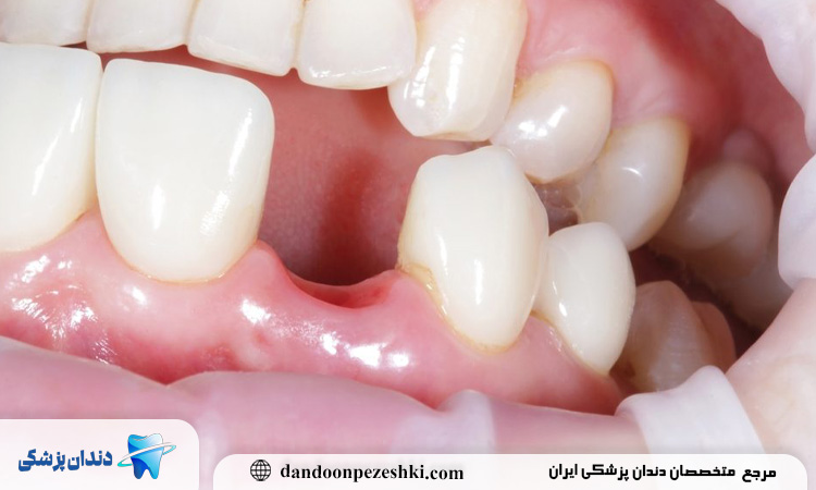 مدت زمان ترمیم لثه بعد از کشیدن دندان