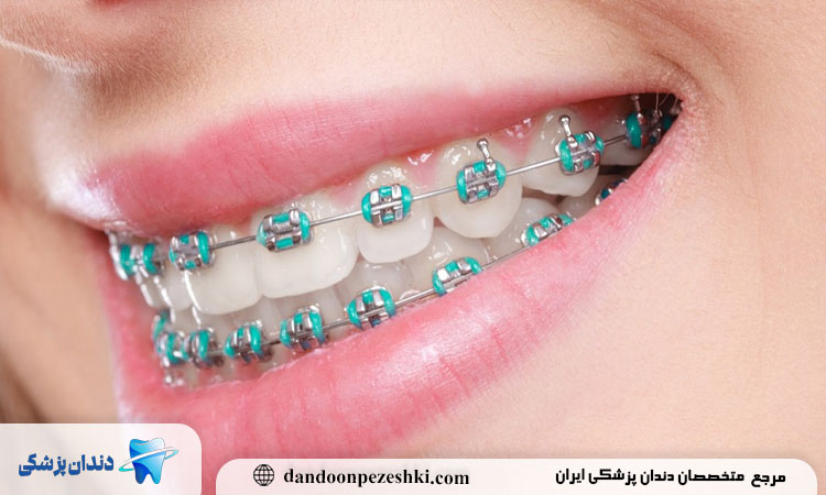 چالش ارتودنسی در بزرگسالان