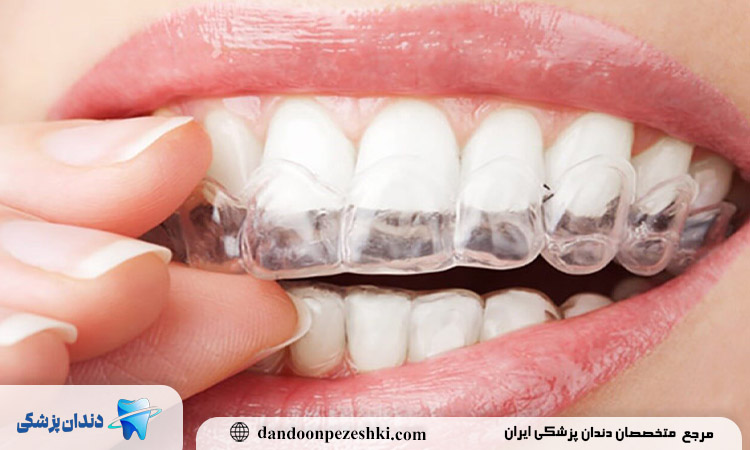 مزایای ارتودنسی سریع