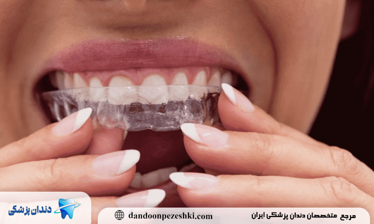 مزایای ارتودنسی شفاف