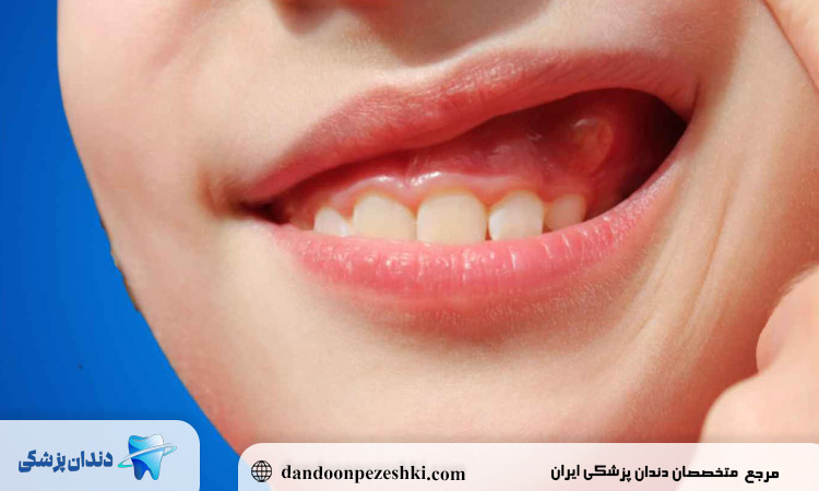 دندان کودکان