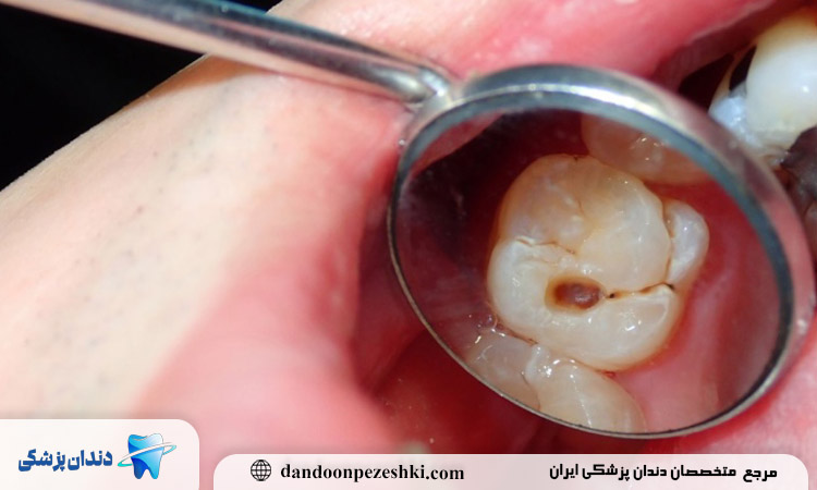 آیا دندان خراب را می شود کامپوزیت کرد؟