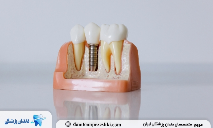 اتصال روکش ایمپلنت