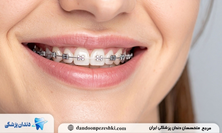 ارتودنسی در سن 30 سالگی