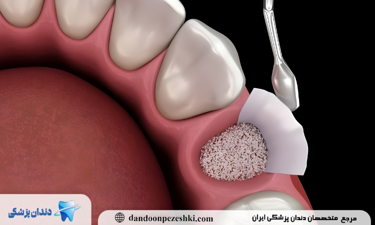 پودر استخوان ایمپلنت