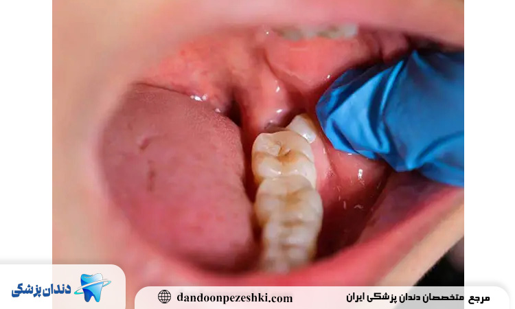 عفونت دندان عقل