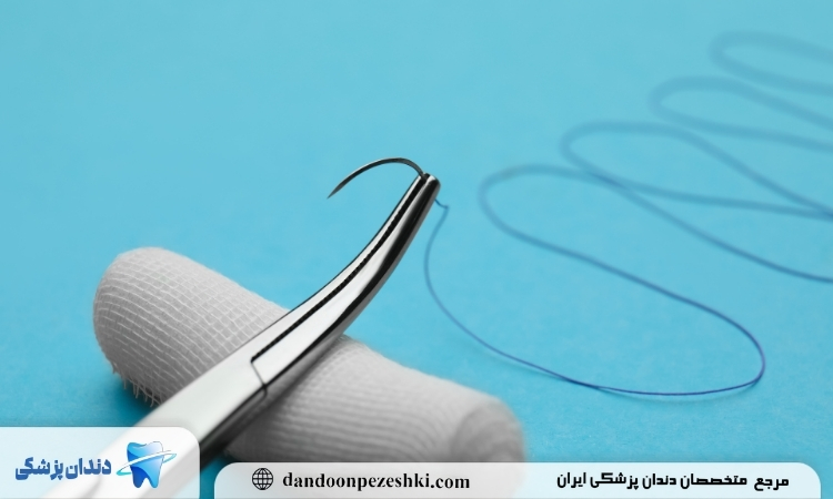 انواع بخیه دندانپزشکی