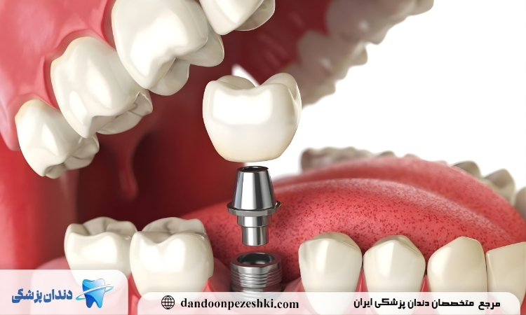 ایمپلنت دندان