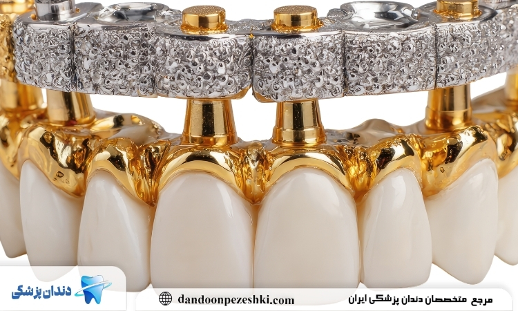 دندان طلا