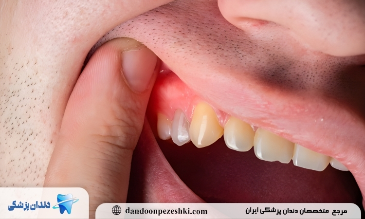 انواع ورم لثه