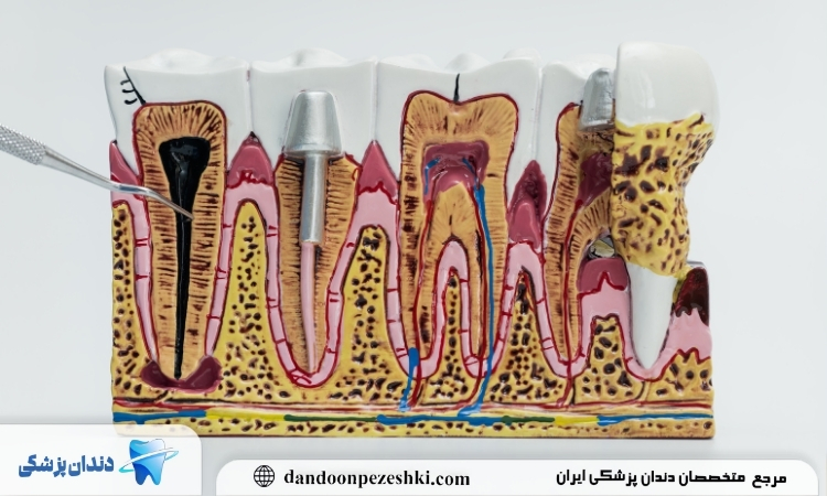 عفونت دندان