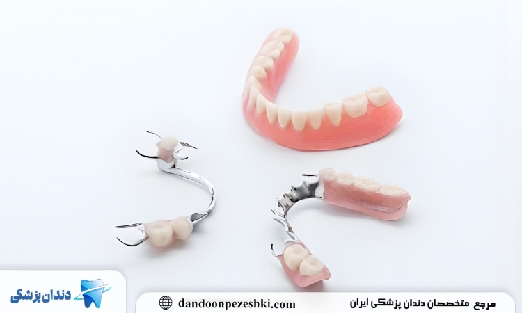 ایمپلنت دندان