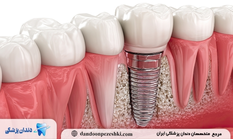 ایمپلنت دندان با چسب