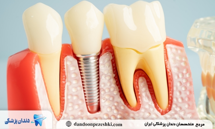 ایمپلنت دندان