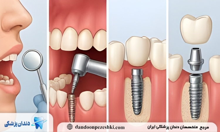 ایمپلنت دندان