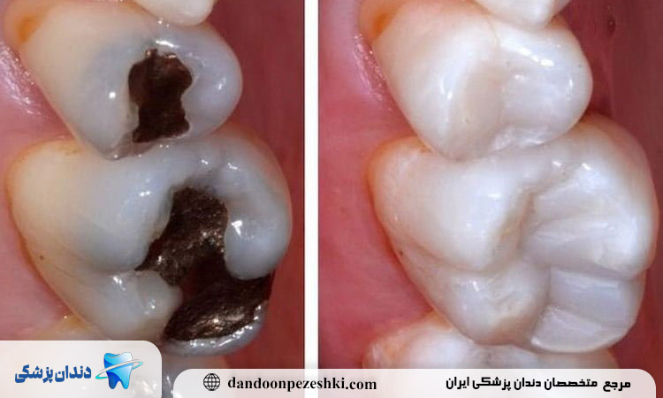 پر کردن دندان