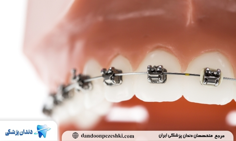 مراحل ارتودنسی