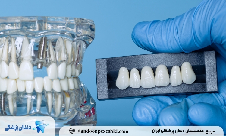 بریچ دندان فک بالا