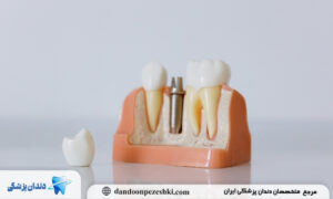 بعد از ایمپلنت چه بخوریم؟