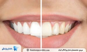 بلیچینگ دندان در خانه بهتر است یا در مطب؟