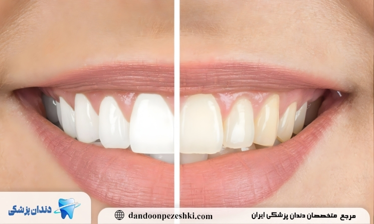 بلیچینگ دندان در خانه بهتر است یا در مطب؟
