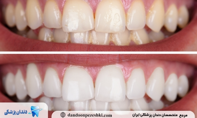 بلیچینگ دندان