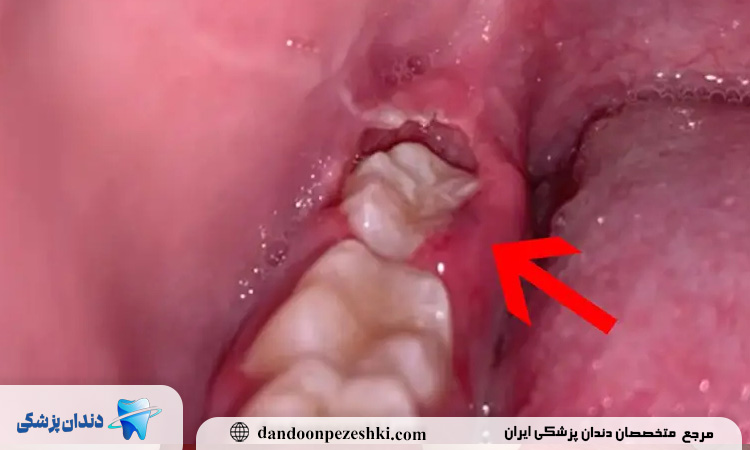 بهبودی عفونت دندان عقل چقدر طول می کشد؟