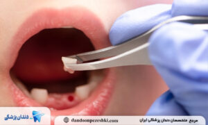  بهترین جایگزین دندان کشیده شده کودکان
