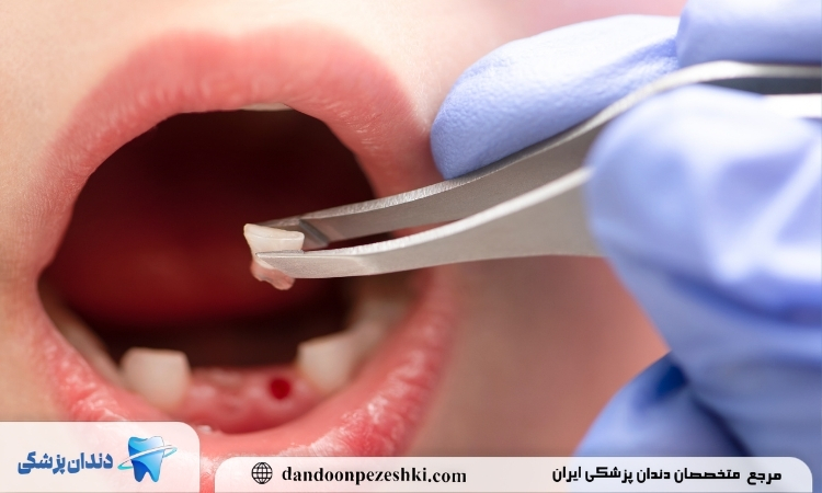  بهترین جایگزین دندان کشیده شده کودکان