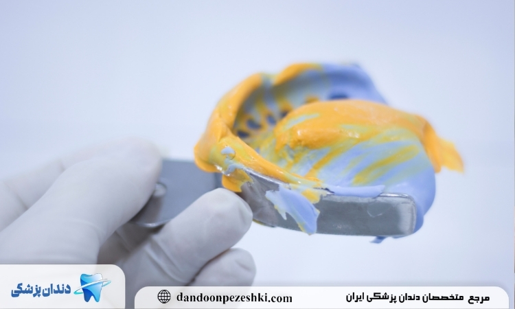 بهترین زمان قالبگیری دندان