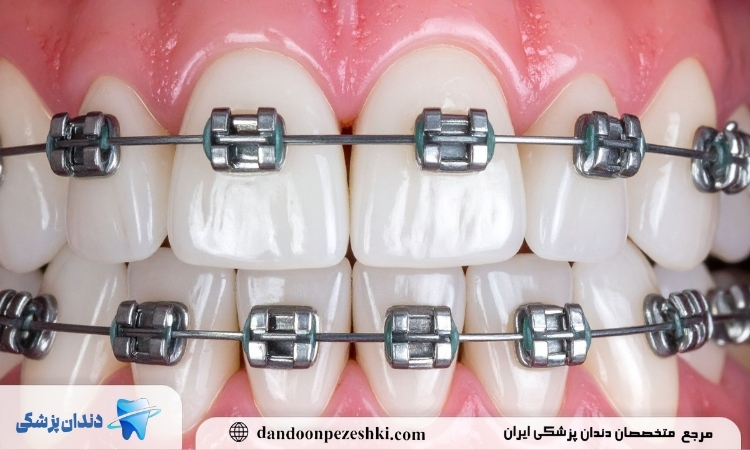 ارتودنسی دندان
