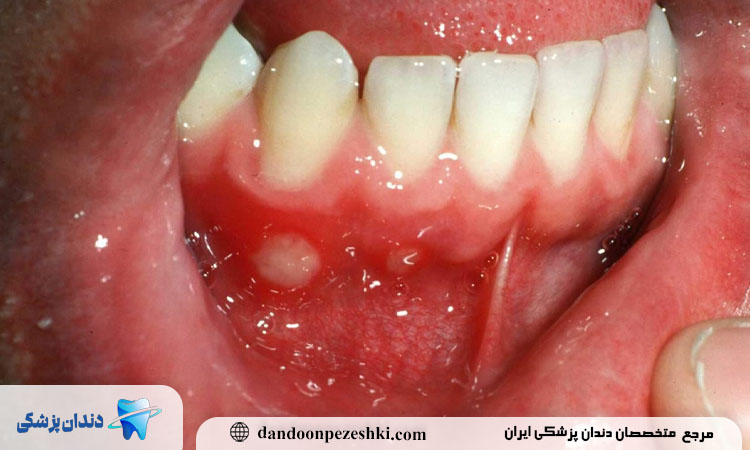 شکستگی دندان جلو