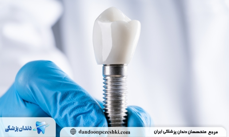 تاثیر ایمپلنت بر صورت