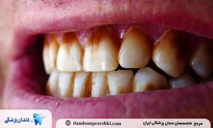 اثر سیگار بر دندان