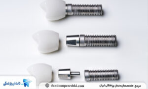تاج دندان ایمپلنت چیست؟