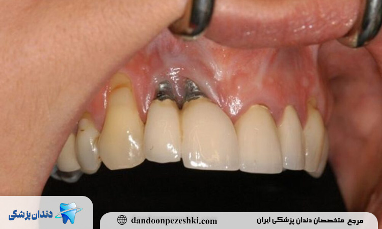 تب و لرز و عفونت ایمپلنت