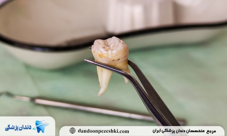 نقاهت جراحی دندان عقل