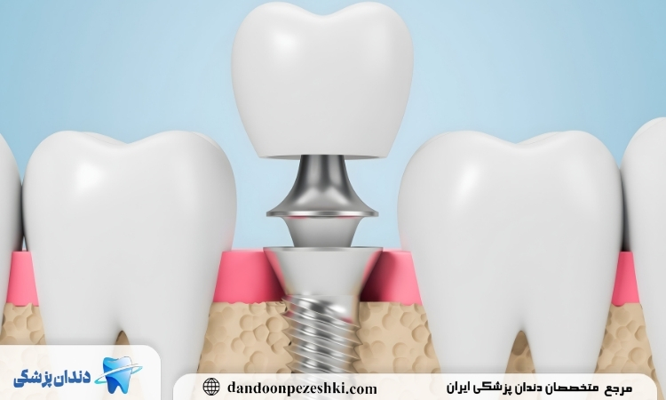 ایمپلنت چیست؟