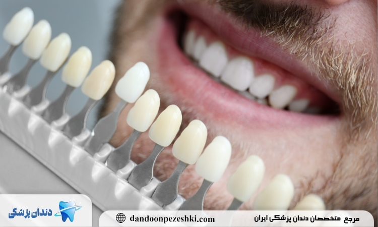 تفاوت قیمت لمینت و کامپوزیت