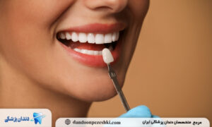 تفاوت لمینت و کامپوزیت و بلیچینگ