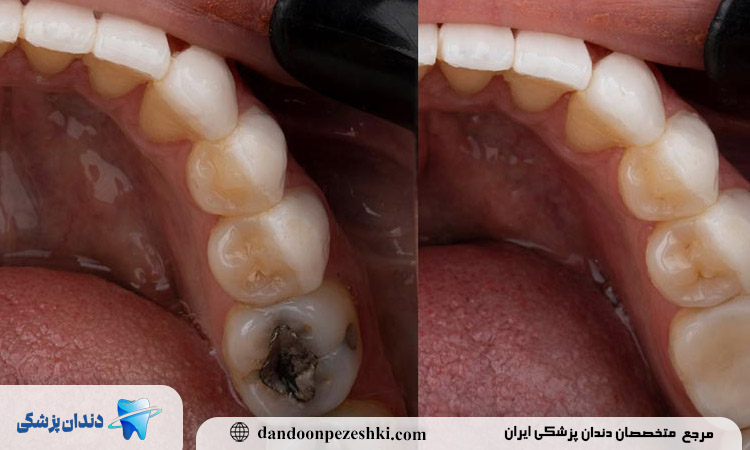 تفاوت پر کردن با روکش دندان
