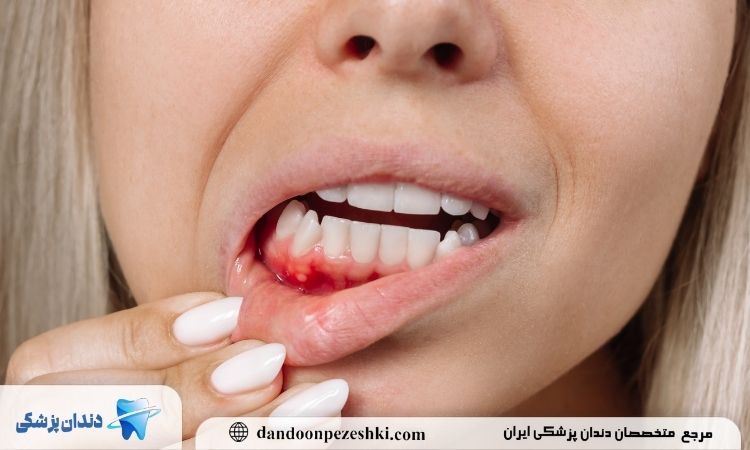 پیوند بافت لثه