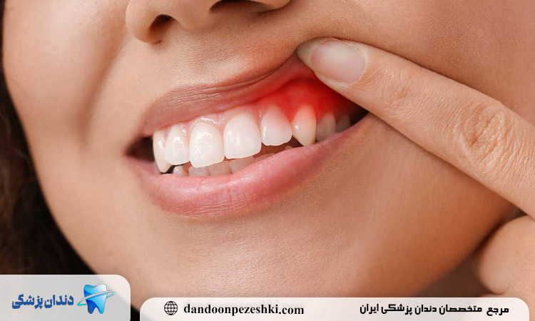 جویدن یک طرفه غذا